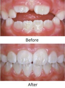 Before & After of Teeth
